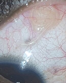 NEOflorax помогна да се отървете от червей в окото